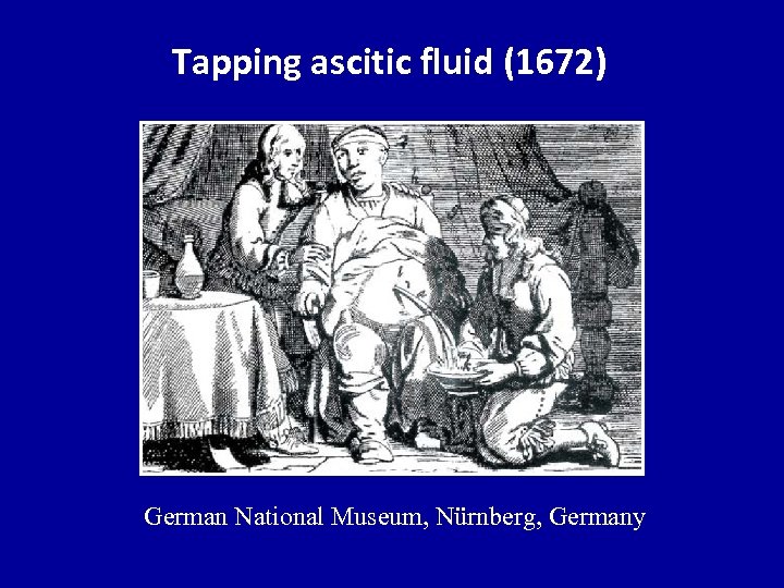 Tapping ascitic fluid (1672) German National Museum, Nürnberg, Germany 