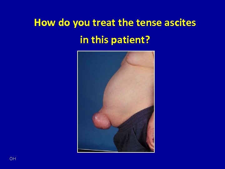 How do you treat the tense ascites in this patient? OH 