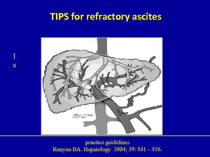 TIPS for refractory ascites I s practice guidelines Runyon BA. Hepatology 2004; 39: 841