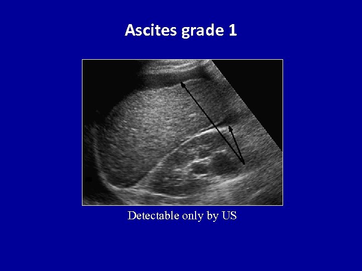 Ascites grade 1 Detectable only by US 