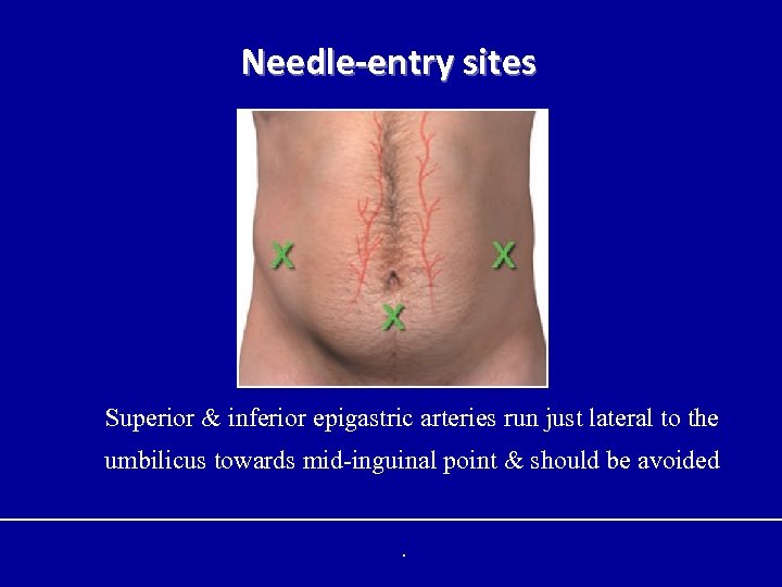 Needle-entry sites Superior & inferior epigastric arteries run just lateral to the umbilicus towards