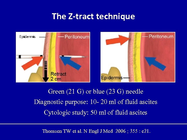 The Z-tract technique Green (21 G) or blue (23 G) needle Diagnostic purpose: 10