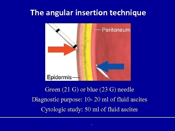 The angular insertion technique Green (21 G) or blue (23 G) needle Diagnostic purpose: