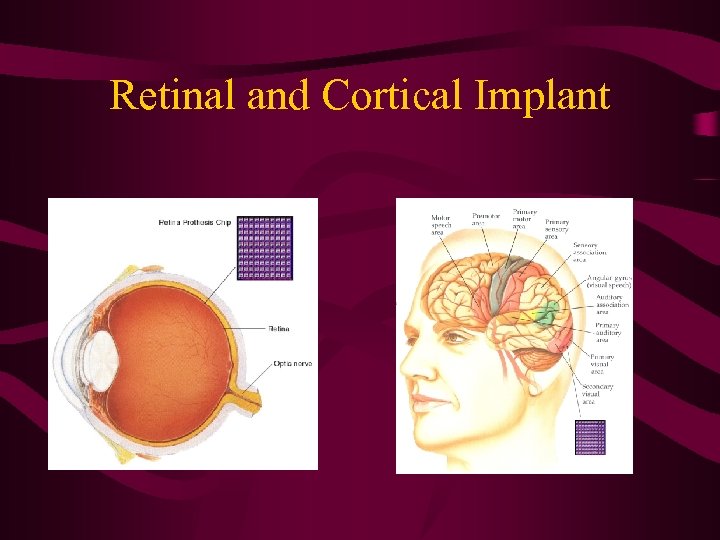 Retinal and Cortical Implant 
