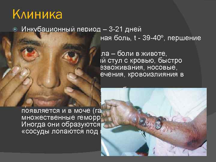 Клиника Инкубационный период – 3 -21 дней Начало – острое: головная боль, t -