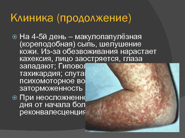 Клиника (продолжение) На 4 -5 й день – макулопапулёзная (кореподобная) сыпь, шелушение кожи. Из-за