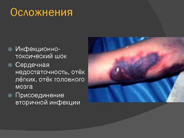 Осложнения Инфекционнотоксический шок Сердечная недостаточность, отёк лёгких, отёк головного мозга Присоединение вторичной инфекции 