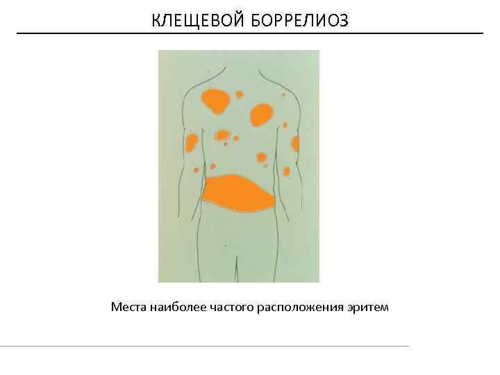 КЛЕЩЕВОЙ БОРРЕЛИОЗ Места наиболее частого расположения эритем 