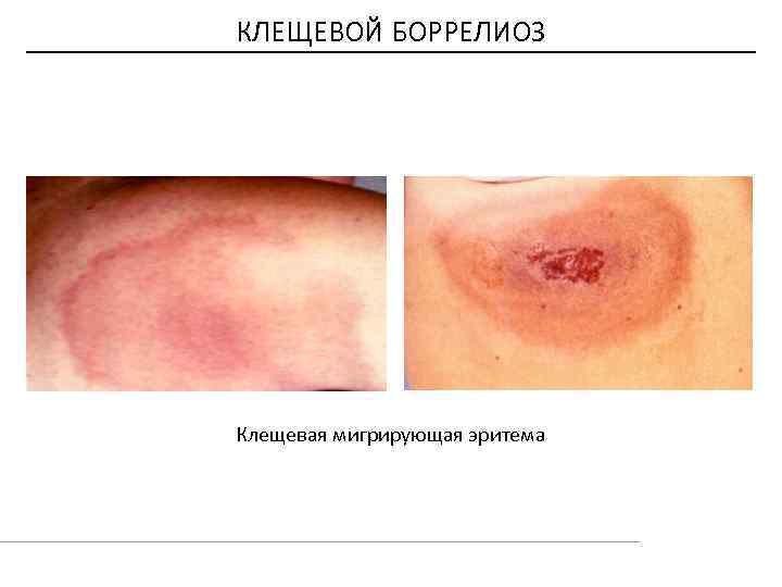 КЛЕЩЕВОЙ БОРРЕЛИОЗ Клещевая мигрирующая эритема 