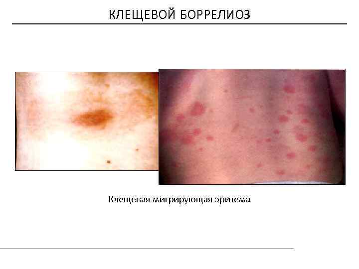 КЛЕЩЕВОЙ БОРРЕЛИОЗ Клещевая мигрирующая эритема 