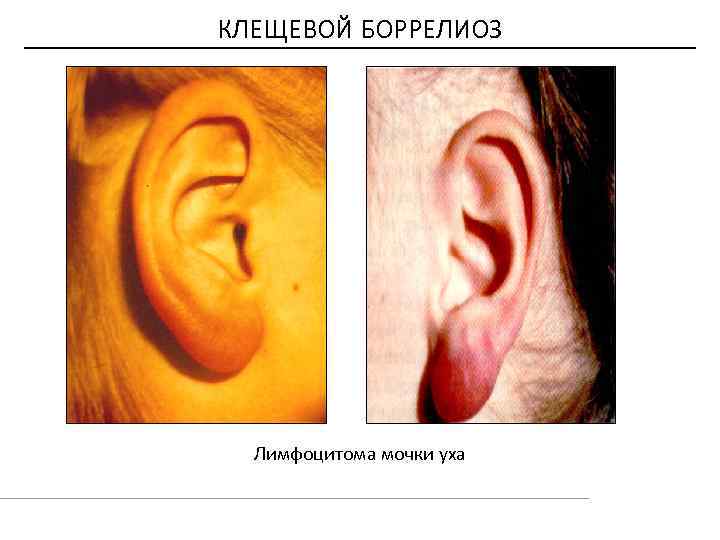 КЛЕЩЕВОЙ БОРРЕЛИОЗ Лимфоцитома мочки уха 