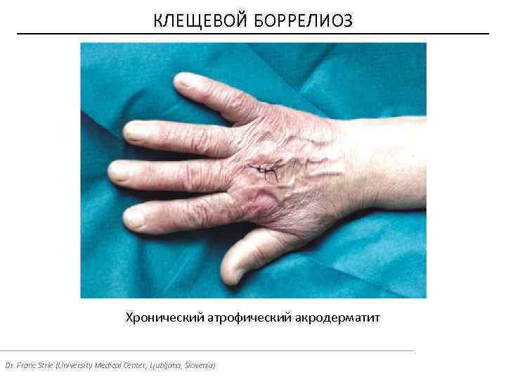 КЛЕЩЕВОЙ БОРРЕЛИОЗ Хронический атрофический акродерматит Dr. Franc Strle (University Medical Center, Ljubljana, Slovenia) 