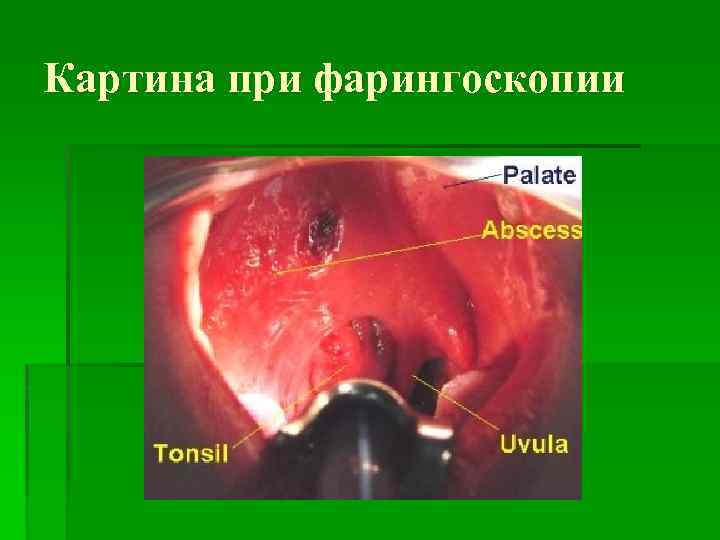 Картина при фарингоскопии 