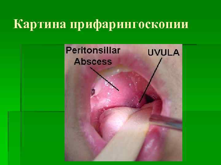 Картина прифарингоскопии 