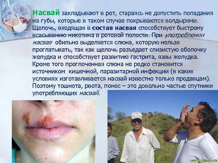 n Насвай закладывают в рот, стараясь не допустить попадания на губы, которые в таком