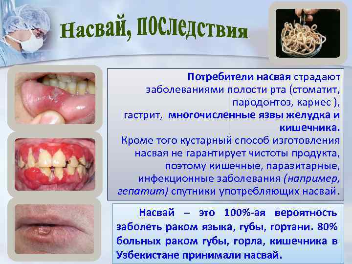 Потребители насвая страдают заболеваниями полости рта (стоматит, пародонтоз, кариес ), гастрит, многочисленные язвы желудка