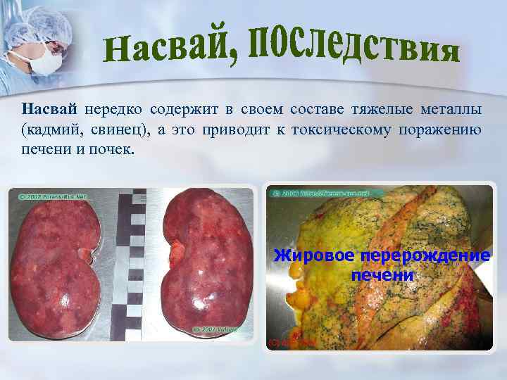 Насвай нередко содержит в своем составе тяжелые металлы (кадмий, свинец), а это приводит к