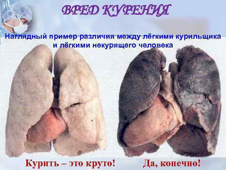 ВРЕД КУРЕНИЯ Наглядный пример различия между лёгкими курильщика и лёгкими некурящего человека Курить –