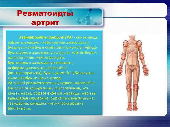 Ревматоидты артрит Ревматоидты артрит (РА) - синовиалды қабықтың үдемелі қабынуынан шеміршектің бұзылуы және буын