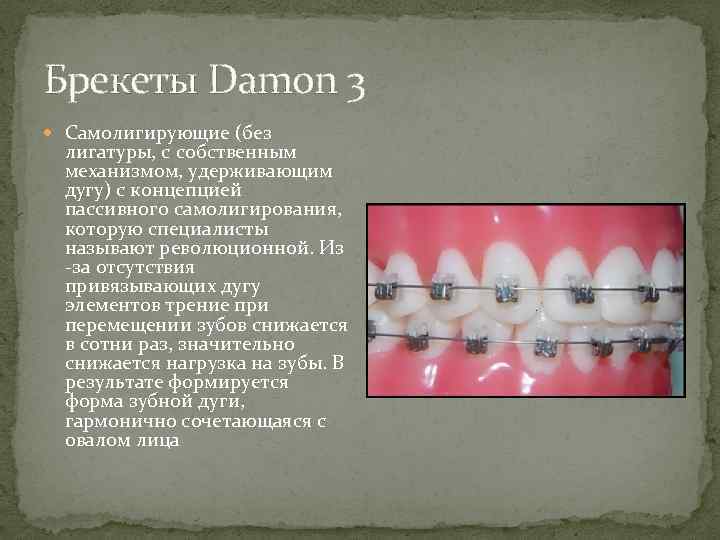 Брекеты Damon 3 Самолигирующие (без лигатуры, с собственным механизмом, удерживающим дугу) с концепцией пассивного