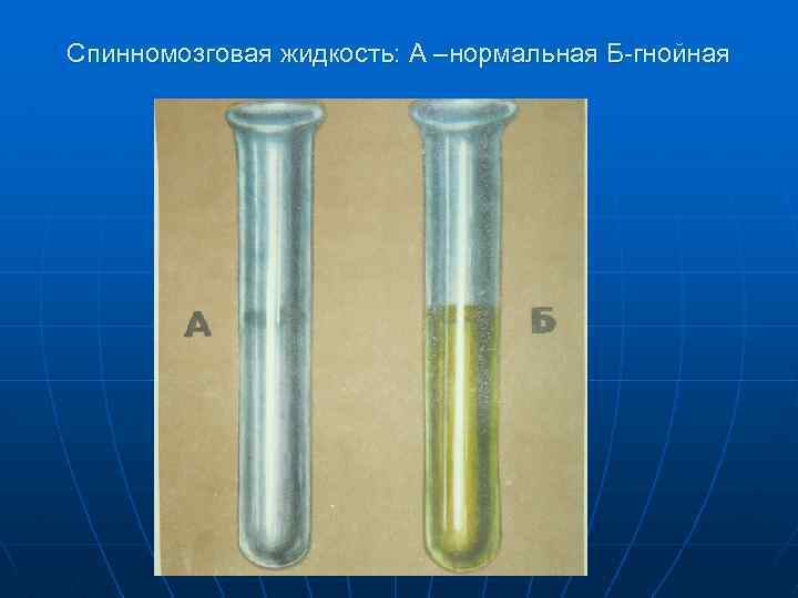 Спинномозговая жидкость: А –нормальная Б-гнойная 