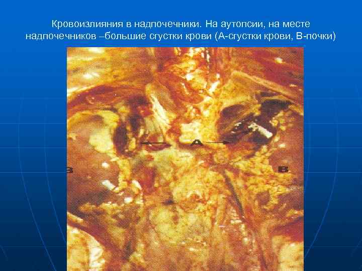 Кровоизлияния в надпочечники. На аутопсии, на месте надпочечников –большие сгустки крови (А-сгустки крови, В-почки)