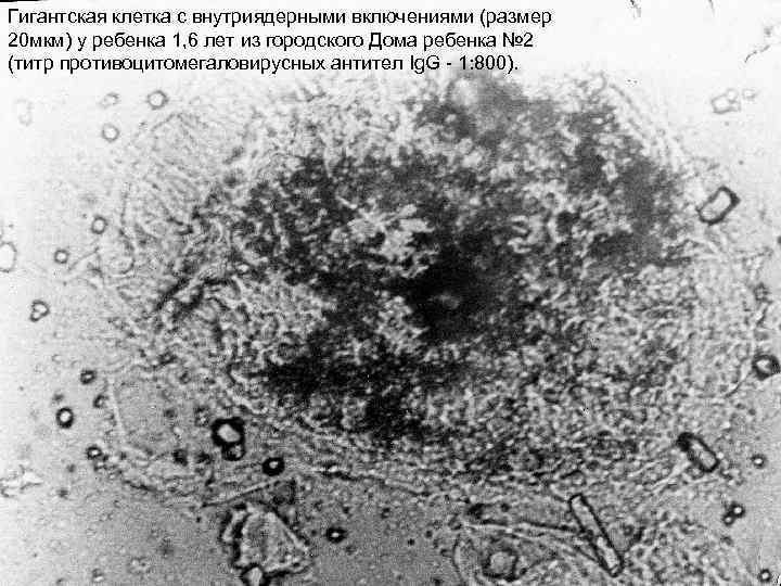 Гигантская клетка с внутриядерными включениями (размер 20 мкм) у ребенка 1, 6 лет из