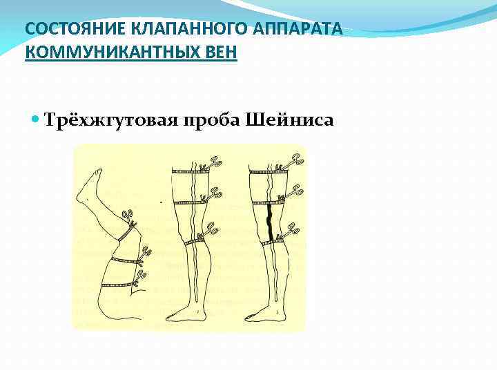 СОСТОЯНИЕ КЛАПАННОГО АППАРАТА КОММУНИКАНТНЫХ ВЕН Трёхжгутовая проба Шейниса 