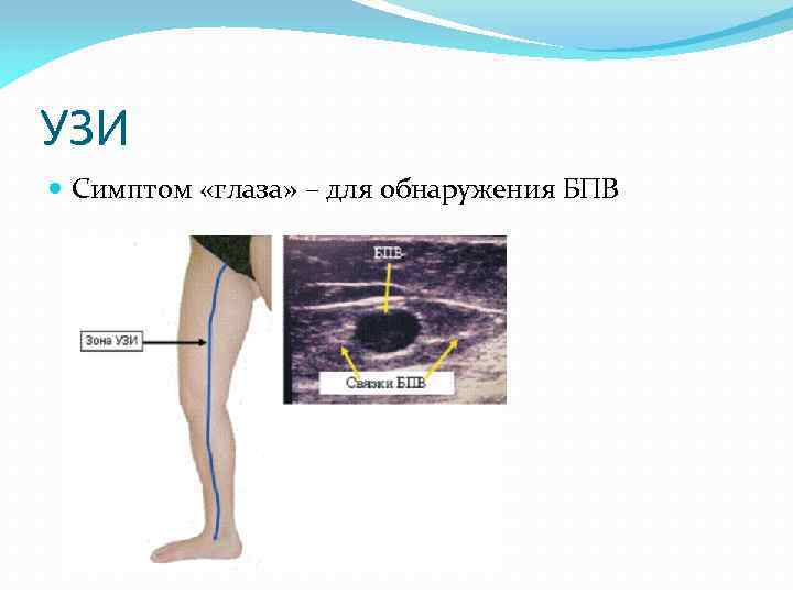 УЗИ Симптом «глаза» – для обнаружения БПВ 