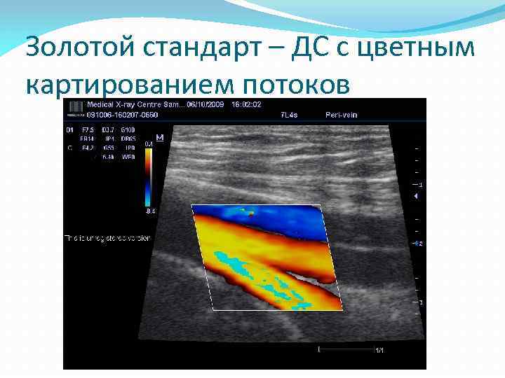 Золотой стандарт – ДС с цветным картированием потоков 