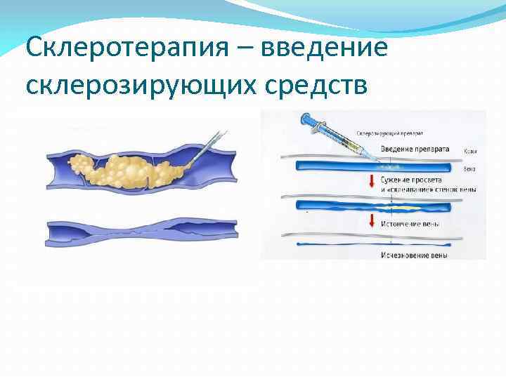 Склеротерапия – введение склерозирующих средств 