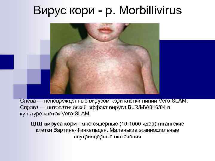 Вирус кори - p. Morbillivirus Слева — неповрежденные вирусом кори клетки линии Vero-SLAM. Справа