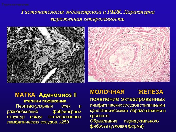 Аденомиоз что это такое у женщин. Аденомиоз матки 2 степени.