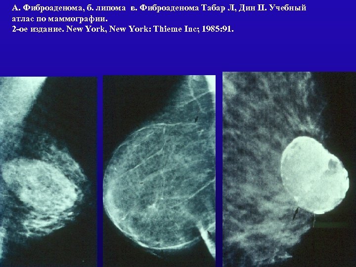 Липома молочной железы на маммографии фото и описание