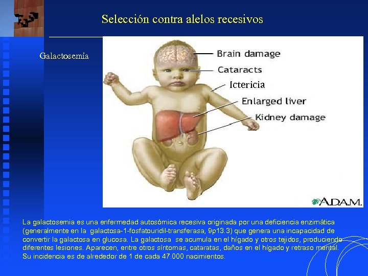 Selección contra alelos recesivos Galactosemia Ictericia La galactosemia es una enfermedad autosómica recesiva originada