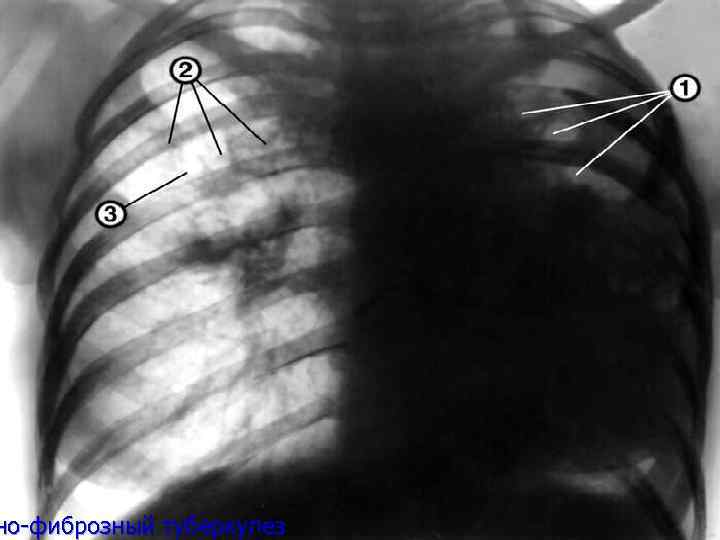 но-фиброзный туберкулез 