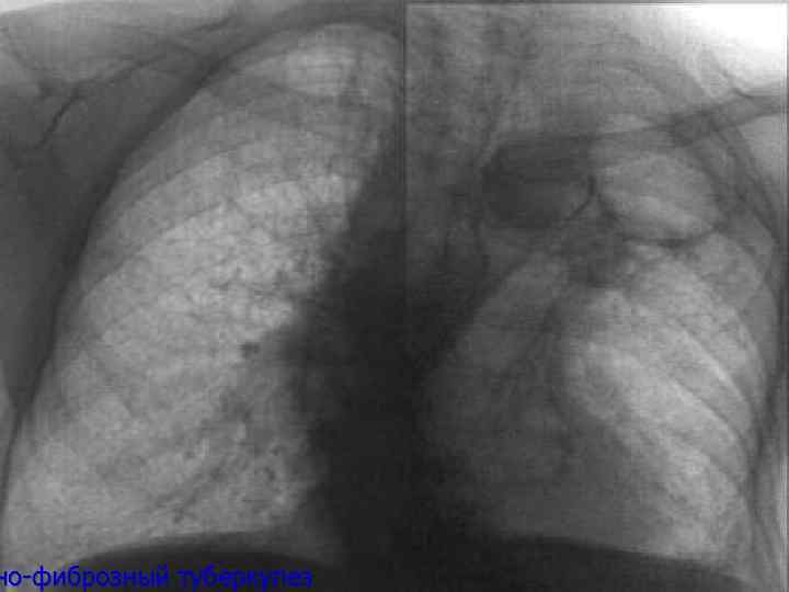 но-фиброзный туберкулез 
