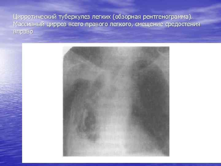 Цирротический туберкулез легких (обзорная рентгенограмма). Массивный цирроз всего правого легкого, смещение средостения вправо 