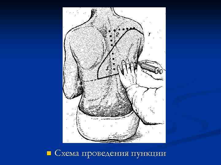 n Схема проведения пункции 