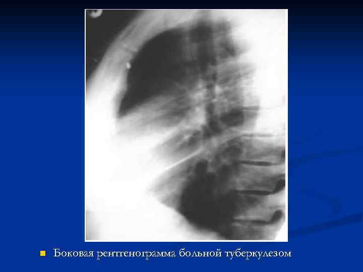 n Боковая рентгенограмма больной туберкулезом 