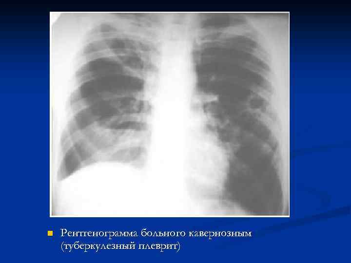 n Рентгенограмма больного кавернозным (туберкулезный плеврит) 