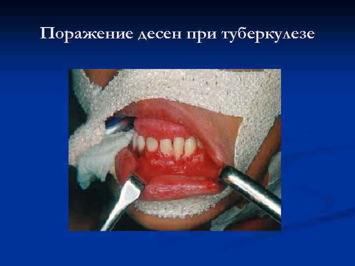 Поражение десен при туберкулезе 