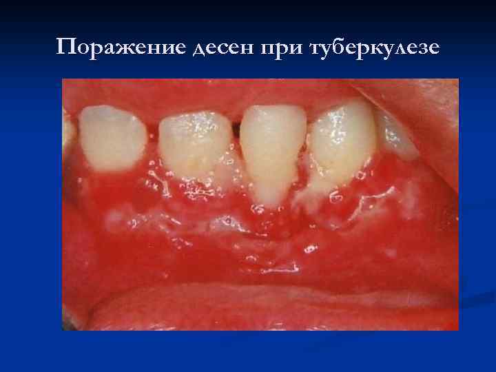 Поражение десен при туберкулезе 