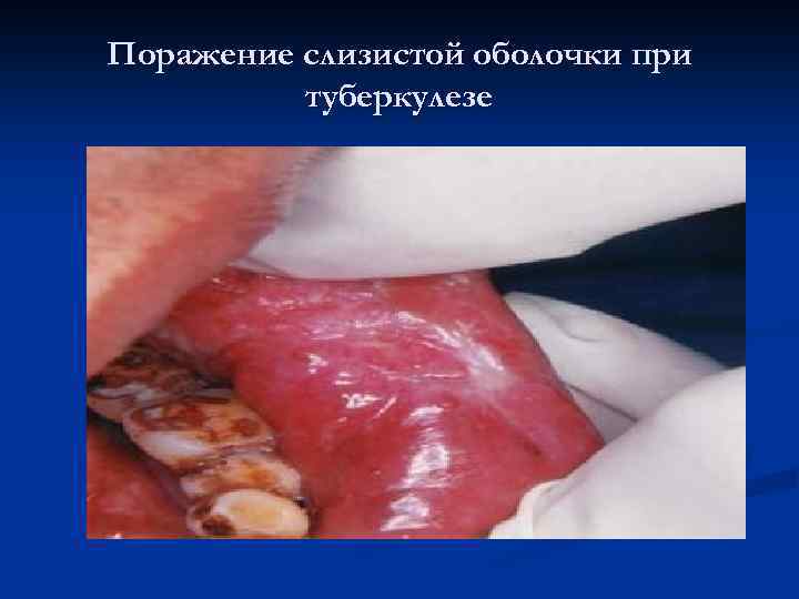 Поражение слизистой оболочки при туберкулезе 