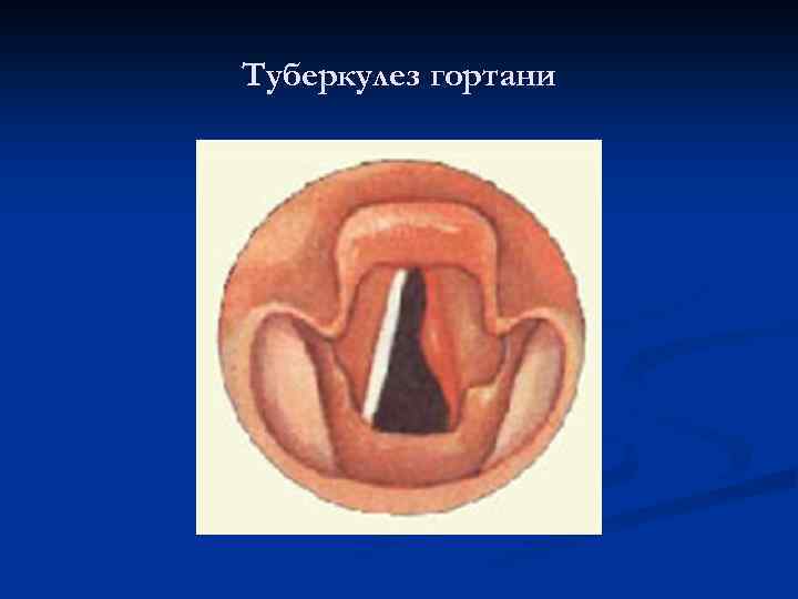 Туберкулез гортани 