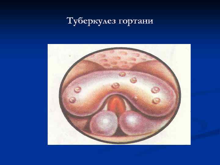 Туберкулез гортани 