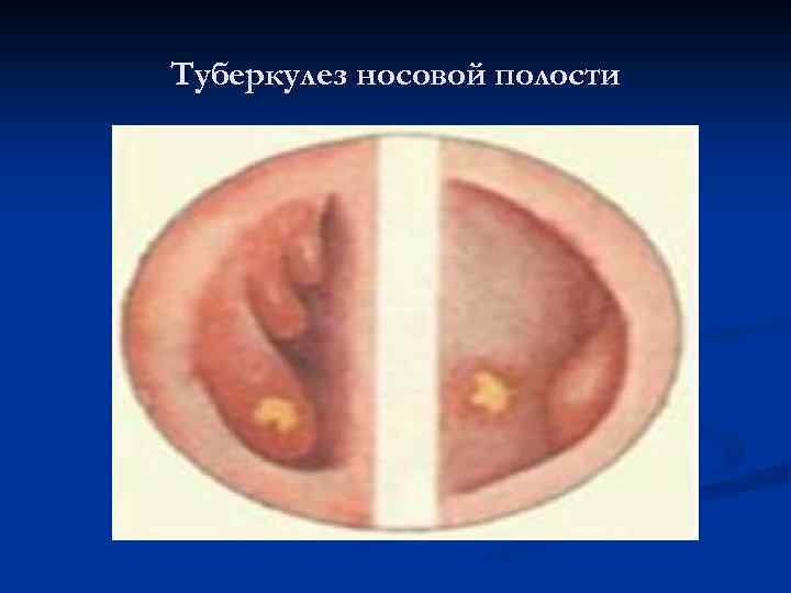Туберкулез носовой полости 