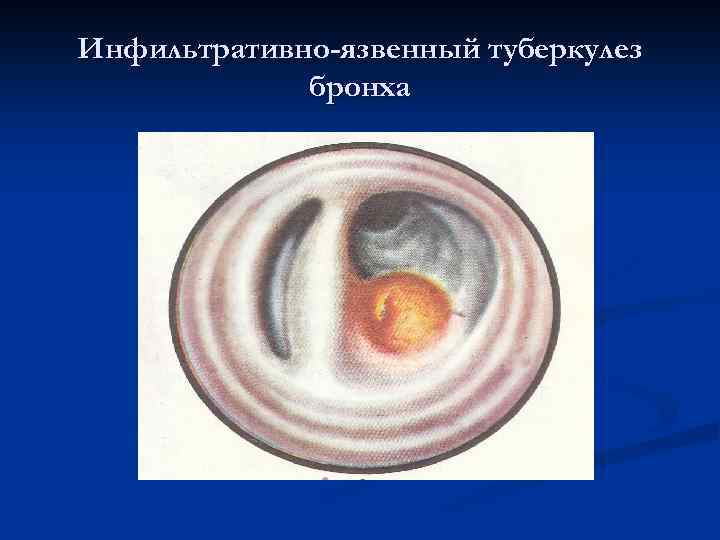 Инфильтративно-язвенный туберкулез бронха 