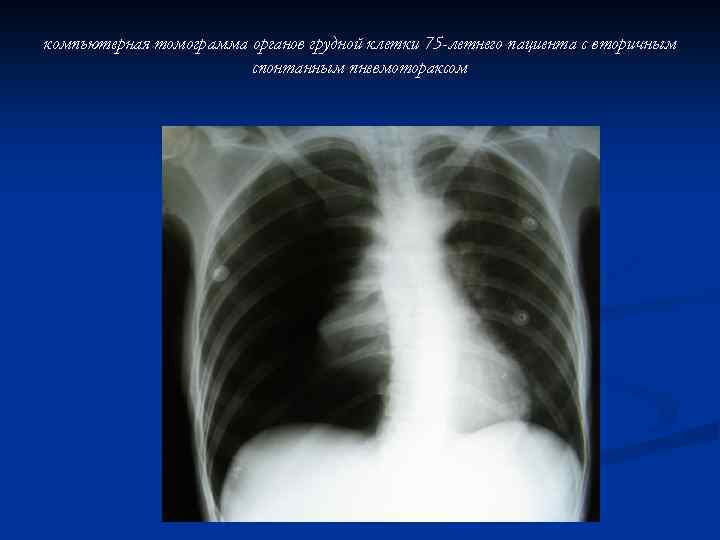 компьютерная томограмма органов грудной клетки 75 -летнего пациента с вторичным спонтанным пневмотораксом 