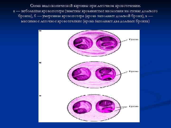 Схема эндоскопической картины при легочном кровотечении. а — небольшая кровопотеря (заметны кровянистые наслоения на